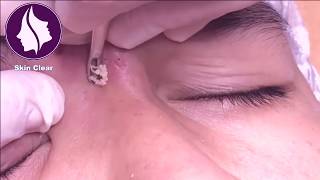 Blackheads Removal On Forehead  Get rid of Pimples  16 [upl. by Porche]