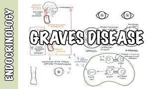 Graves Disease  Overview causes pathophysiology investigations and treatment [upl. by Eceinwahs]