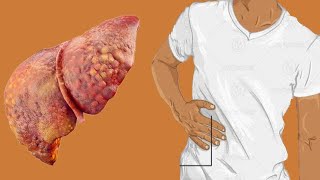 Cirrhosis Of Liver Life Expectancy By Stage [upl. by Cathey]