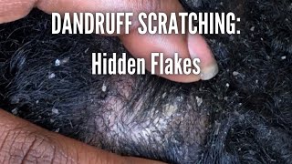 DANDRUFF SCRATCHING  Hidden Flakes [upl. by Ettezil]