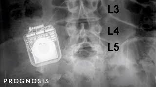 Meralgia Paresthetica Soft Tissue Release  TFL and Psoas Chiropractic Treatment [upl. by Frannie]