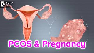 What happens if I have PCOS and I get pregnant  Dr Bala R [upl. by Hanahs]