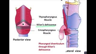 ESOPHAGEAL DIVERTICULUM [upl. by Ahiel446]