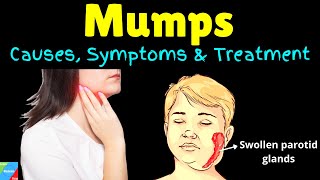 Mumps  Parotitis  Pathology  Introduction pathogenesis clinical feature diagnosis treatment [upl. by Kaylyn692]