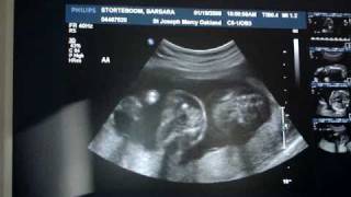 Twins20 week ultrasound [upl. by Jacquie]