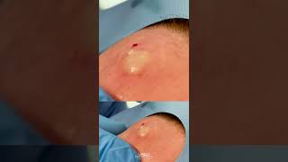 Forehead Cyst Squeezed  CONTOUR DERMATOLOGY shorts [upl. by Ahtaga138]