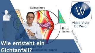 Gicht 😡 Oft unterschätzt aber sehr schmerzhaft Akuter Gichtanfall  Ursachen Symptome amp Therapie [upl. by Nosydam]