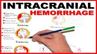 Hemorrhagic Stroke  Intracerebral Hemorrhage amp Subarachnoid Hemorrhage  Management [upl. by Adolfo]