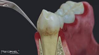 Tratamiento Periodontal Básico para pacientes [upl. by Wenger]