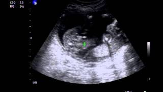 My baby Boys Ultrasound 5 Months [upl. by Nomsed]