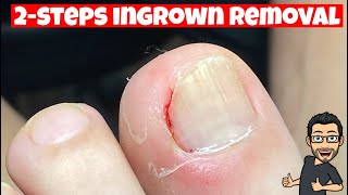 HOW TO REMOVE AN INGROWN TOENAIL [upl. by Ruskin]