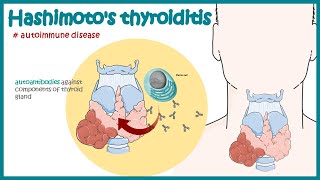 Hashimotos thyroiditis  Autoimmune diseases [upl. by Nnair17]