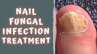 HOW TO TREAT FUNGAL NAIL INFECTION  TINEA UNGUIUM  ONYCHOMYCOSIS [upl. by Adnam903]