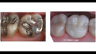 Mercury Amalgam Removal and Restoration [upl. by Niletak]