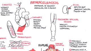 Atherosclerosis  Pathophysiology [upl. by Eliak862]