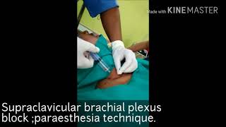 Supraclavicular plexus blockparaesthesia technique [upl. by Petey498]