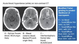 Subarachnoid Haemorrhage [upl. by Picker939]