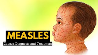 Mumps Signs and symptoms diagnosis treatment complications [upl. by Aneez]