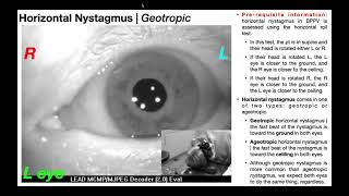 Nystagmus Diagnosis and Treatment Options [upl. by Luing23]