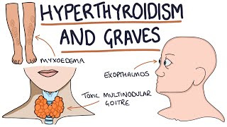 Understanding Hyperthyroidism and Graves Disease [upl. by Herrmann]