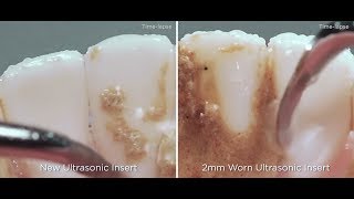 The impacts of ultrasonic insert tip wear  Dentsply Sirona [upl. by Naneek]