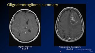 Imaging brain tumors  3  Oligodendrogliomas [upl. by Rol33]