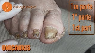 Onicauxis onychomycosis amp callosities Part 1 podologiaintegral [upl. by Jp184]