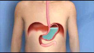 Gastroesophageal Reflux Disease GERD Symptoms and Treatment  Dr Pinakin Patel [upl. by Sammons]