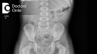 How to diagnose Intussusception  Dr Nagaraj B Puttaswamy [upl. by Annairdua755]