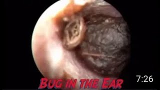 Insect inside the ear [upl. by Cartie]