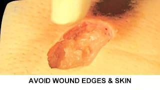 Enzymatic Debridement Demonstration Understand Wound Care [upl. by Inglis]