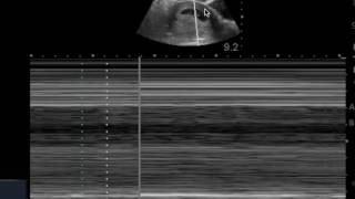 Tutorial on using Mmode on the Sonosite for FHR [upl. by Bozuwa430]