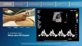 Advanced screening views of the fetal heart  Part 1  4chamber color and PW Doppler [upl. by Aspa]