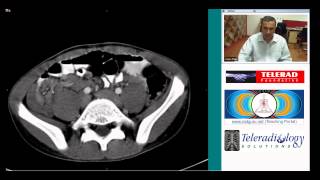 CT scan of ileocolic intusussception by Dr Arjun Kalyanpur [upl. by Ahnavas141]