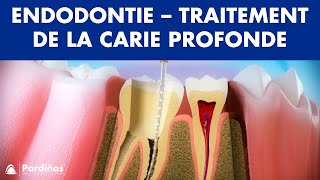 Endodontie  Traitement de la carie profonde © [upl. by Ignacia]