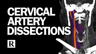 Cervical Arterial Dissections [upl. by Sly]