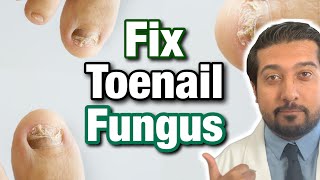 How to Treat Toenail Fungus CORRECTLY  Easy Steps 2021 [upl. by Lucas]