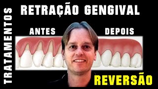 Retração Gengival Tratamentos e Reversão Antes e Depois  Cirurgia Plástica de Gengiva ou Resina [upl. by Okoyk616]