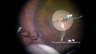 Live Micro Filaria Worm in Anterior Chamber of Eye  Larva of Wuchereria Bancrofti [upl. by Philippine]