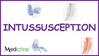 Intussusception  causes types  pathophysiologyfeaturesdx and treatment [upl. by Elacsap]