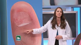 What To Do if Your Toenail Falls Off [upl. by Inail]