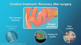 New Therapies for Esophageal Stricture [upl. by Eve]