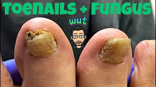 HOW TO CUT THICK TOENAILS WITH FUNGUS [upl. by Ahseital497]