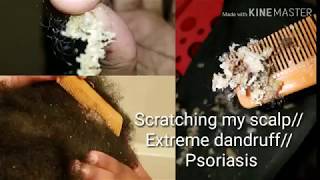 Scratching my scalp Extreme dandruff psoriasis [upl. by Siradal]