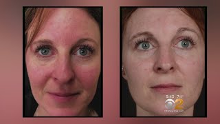 Health Watch New Laser Treatment For Rosacea [upl. by Darees]