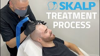 Skalp® Scalp Micropigmentation Treatment Process [upl. by Decrem712]