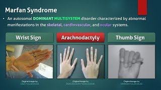 Marfan Syndrome [upl. by Selohcin875]