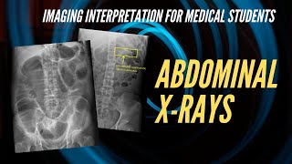 Complex Abdominal Aortic Aneurysm Surgery [upl. by Aya]