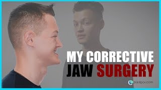 Orthognathic Jaw surgery 2019 before and After [upl. by Enajaras]