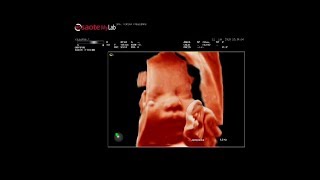 Scan fetal de 20 semanas  Dr Alberto Sosa Olavarría [upl. by Arriek931]